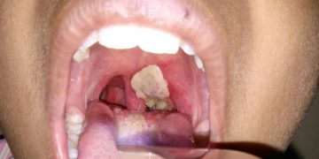 What is the disease diphtheria? Learn about the illness that killed five people in Odisha, India.