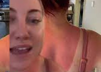 Why should you avoid attempting the newest trend that TikTokers are “sunburning” their acne