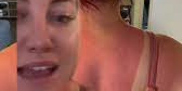 Why should you avoid attempting the newest trend that TikTokers are “sunburning” their acne