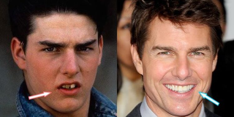 Has Tom Cruise undergone cosmetic procedures to keep his “youthful look”?